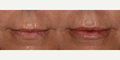 Restylane before and after photo