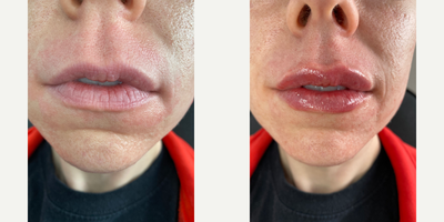 Restylane before and after photo