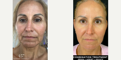 Skin Tightening before and after photo