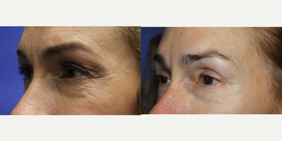 Eyelid Surgery before and after photo