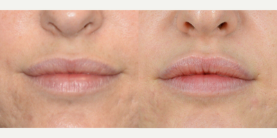 Lip Fillers before and after photo