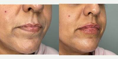 Lip Fillers before and after photo