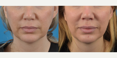 Volbella before and after photo