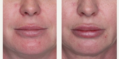 Lip Fillers before and after photo