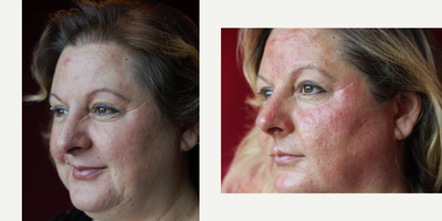 Microneedling before and after photo