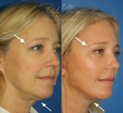 Brow Lift before and after photo