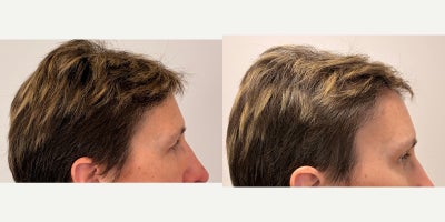 Brow Lift before and after photo