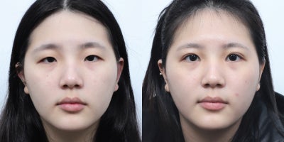 Double Eyelid Surgery before and after photo