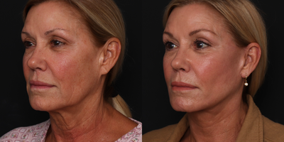 Facelift before and after photo
