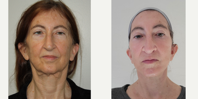 Facelift before and after photo