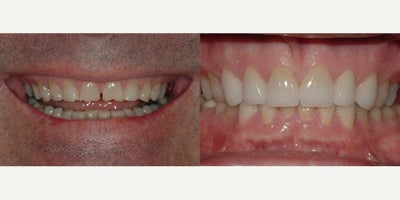 Smile Makeover before and after photo