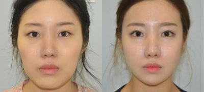 Facial Reconstructive Surgery before and after photo