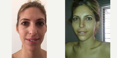 Rhinoplasty before and after photo