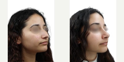 Rhinoplasty before and after photo