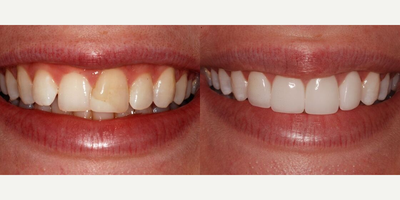 Dental Crown before and after photo