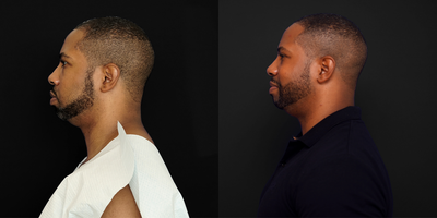 Eyelid Surgery before and after photo