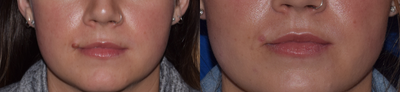 Mole Removal before and after photo