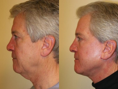 Neck Lift before and after photo