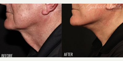 Deep Plane Facelift before and after photo