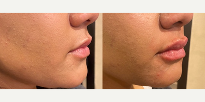 Dermal Fillers before and after photo