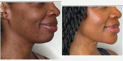 Dermal Fillers before and after photo