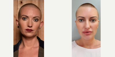 Ear Surgery before and after photo