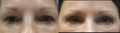 Eyelid Surgery before and after photo