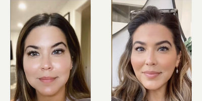 Buccal Fat Removal before and after photo