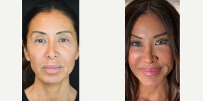 Deep Plane Facelift before and after photo