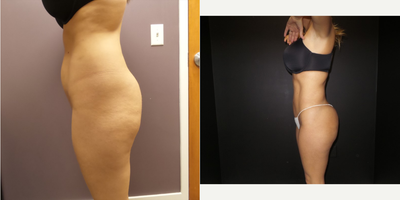 Lipo 360 BBL before and after photo