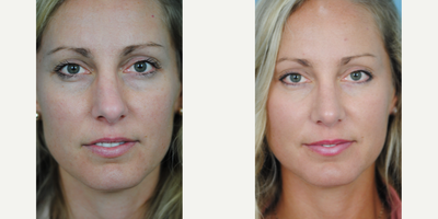 Revision Rhinoplasty before and after photo