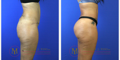 Brazilian Butt Lift before and after photo