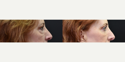 Eyelid Surgery before and after photo