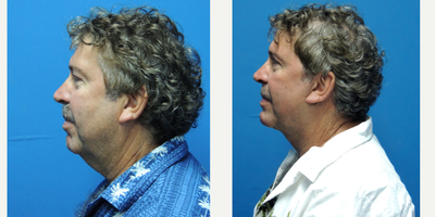 Facelift before and after photo