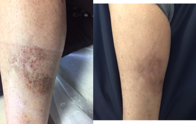 Laser Resurfacing before and after photo