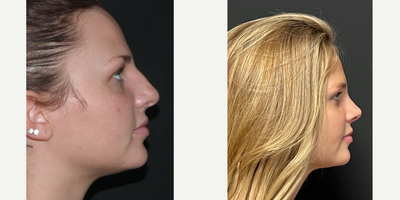 Rhinoplasty before and after photo