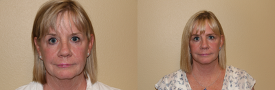 Facelift before and after photo