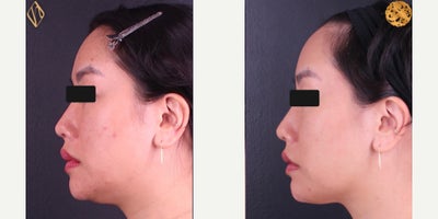 FaceTite before and after photo