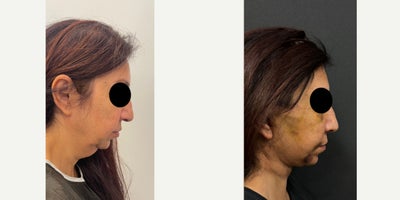 Neck Lift before and after photo