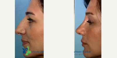 Rhinoplasty before and after photo