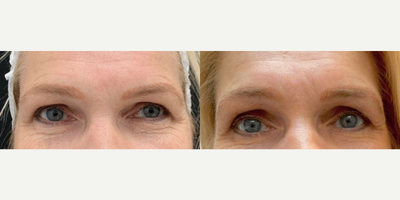 Sofwave before and after photo