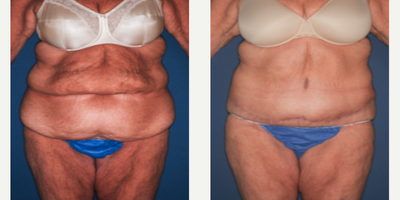 Tummy Tuck before and after photo