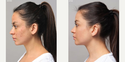 Chemical Peel before and after photo