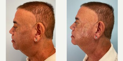 Dermal Fillers before and after photo