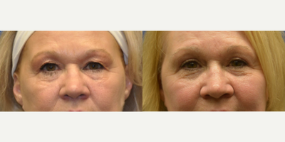 Eyelid Surgery before and after photo