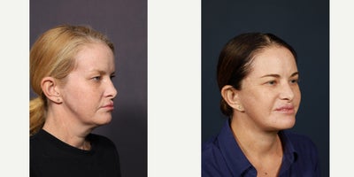 Eyelid Surgery before and after photo