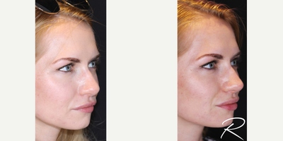 Nonsurgical Nose Job before and after photo