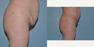 Tummy Tuck before and after photo