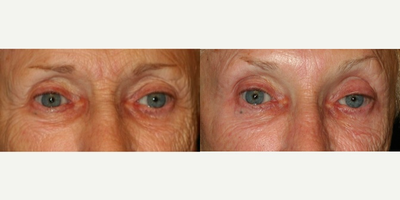 Botox before and after photo