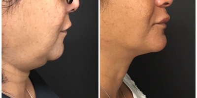 CoolMini before and after photo